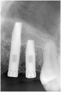 川畑5　埋入後3ヶ月　サイナスリフト